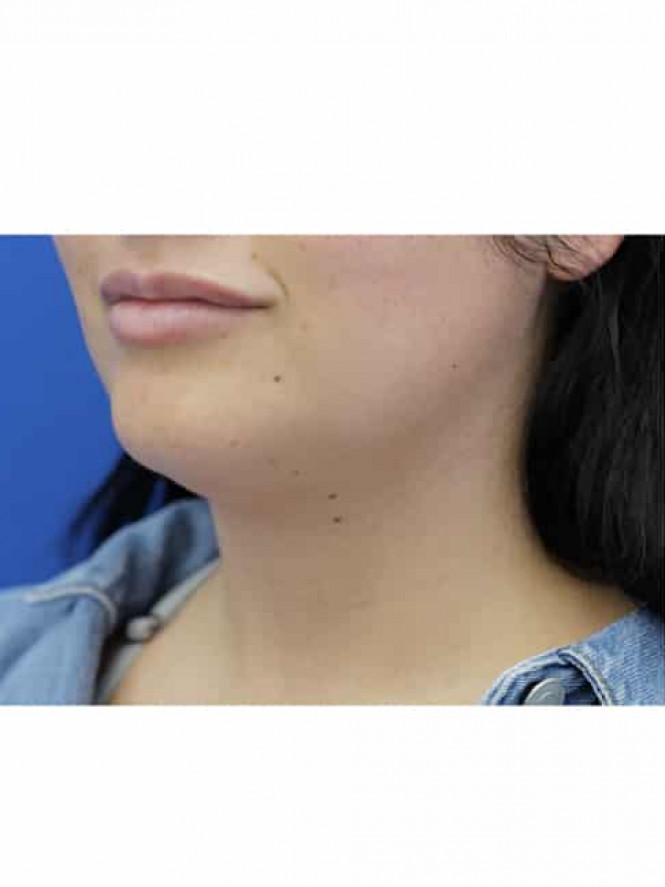 Platysmaplasty Without Skin Resection — Before