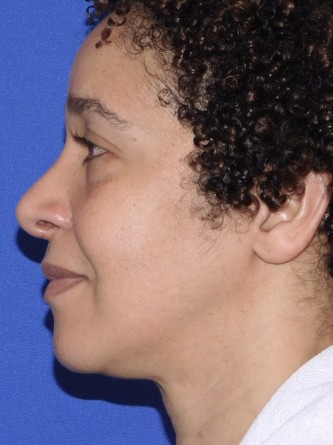 Ethnic Rhinoplasty* — After
