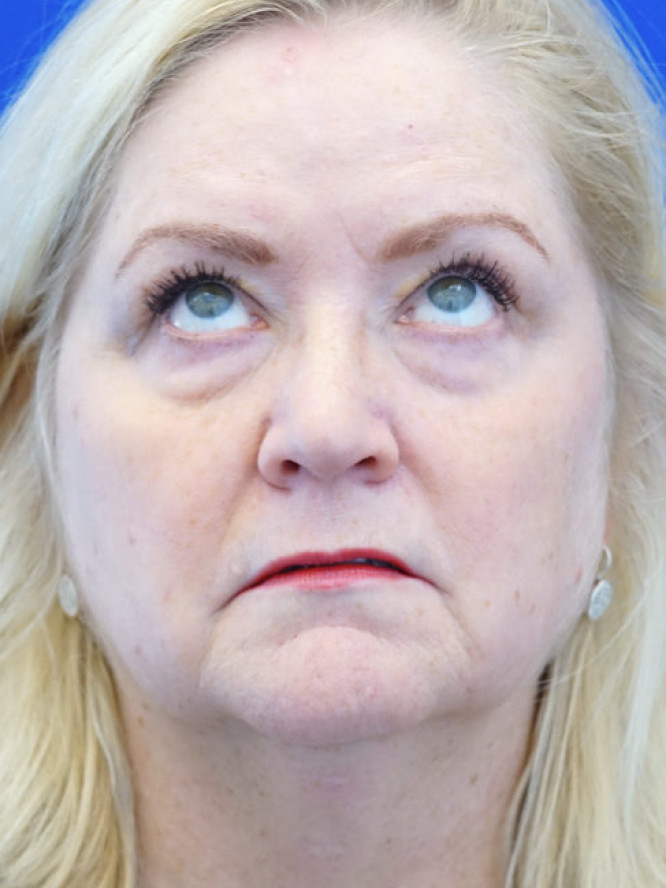 Lower Eyelid Rejuvenation — Before