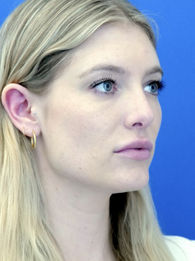 Aesthetic Nasal Contour — After