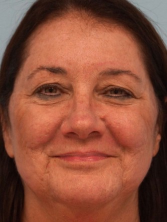 Fractional CO2 Laser Skin Resurfacing3* — After