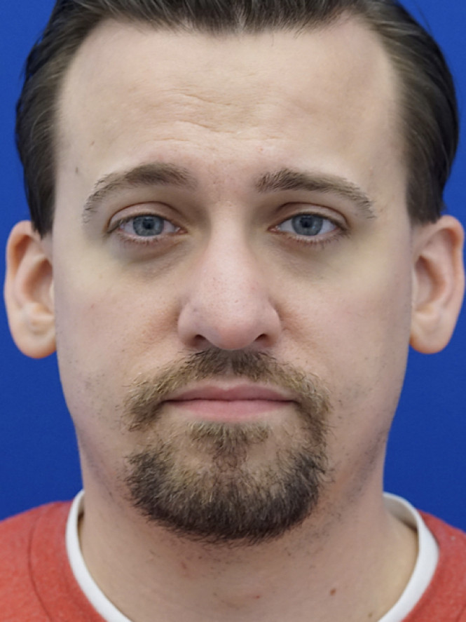 Crooked Thick Skin Nose — After