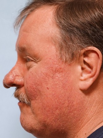 Rhinophyma* — Before