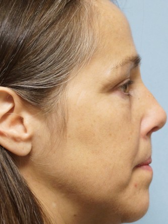 Nasal Septal Perforation2* — After
