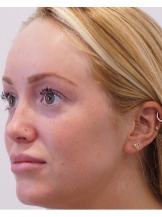Restylane Silk to Upper & Lower Lips* — After