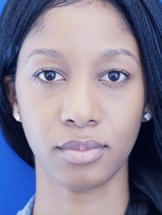 Ethnic Rhinoplasty* — After