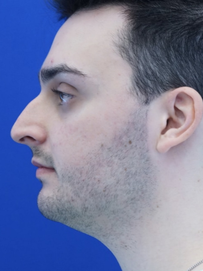 Profile Enhancement — Before