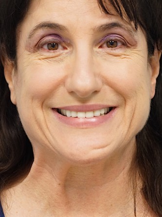 Mini Face and Neck Lift* — Before