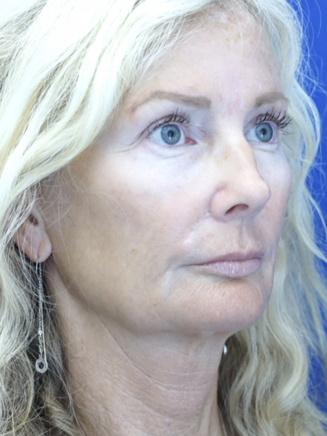 Scintillating Natural Result — Before