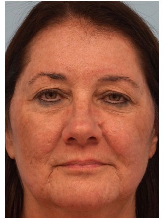 Fractional CO2 Laser Skin Resurfacing3* — After