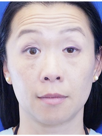 Unilateral Ptosis Repair* — Before