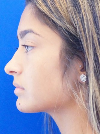 Voluptuous Lip Enhancement* — Before