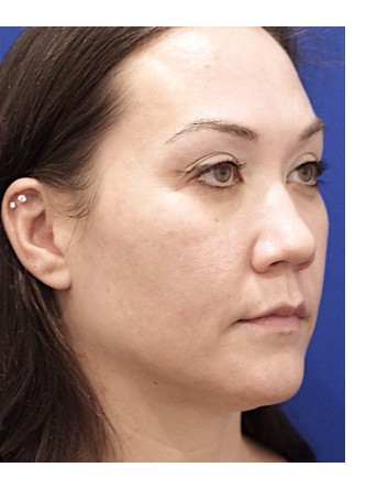 Bull Horn Lip Lift — Before
