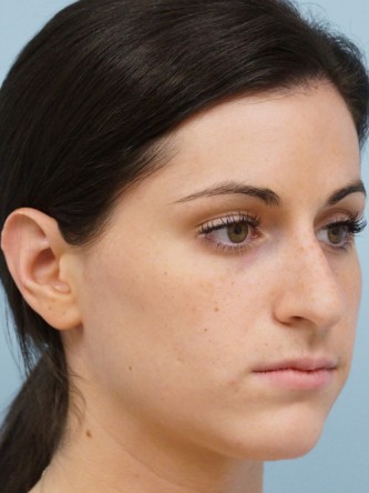 Mild Dorsal Hump & Droopy Tip1* — Before