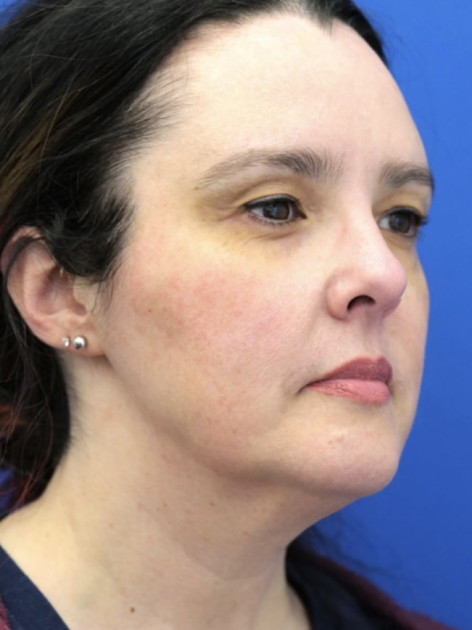 Awesome Jawline — Before
