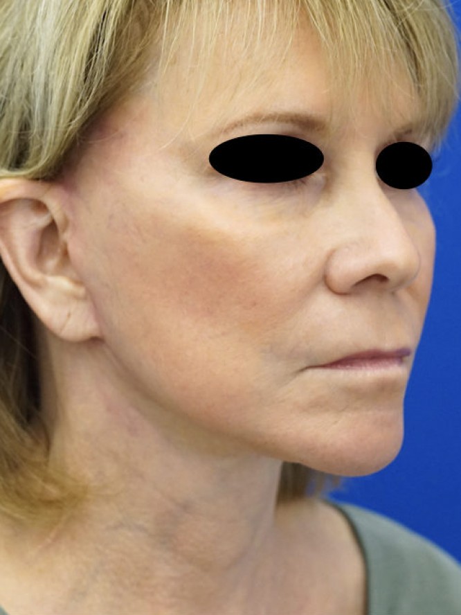 Secondary Deep Plane Facelift — After