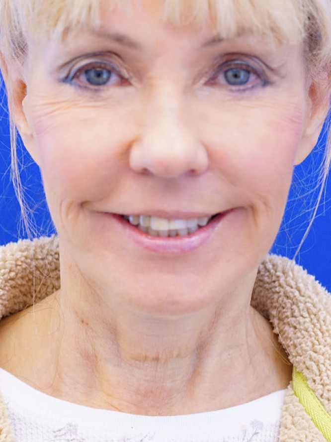 Neck Rejuvenation — Before