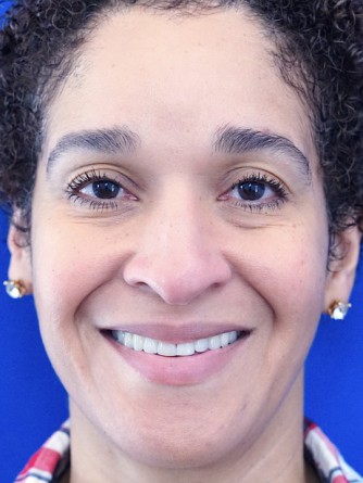 Ethnic Rhinoplasty* — Before