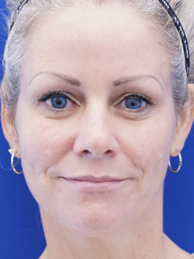 Mild Upper and Lower Lid Skin Trim — Before