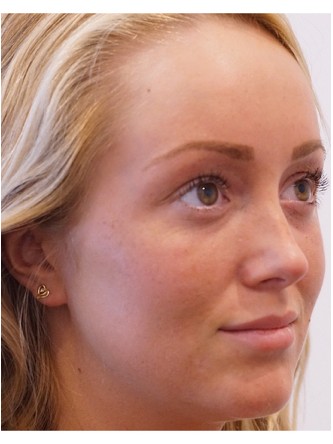 Restylane Silk to Upper & Lower Lips* — Before