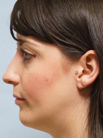 Repair of Nasal Septal Perforation* — Before