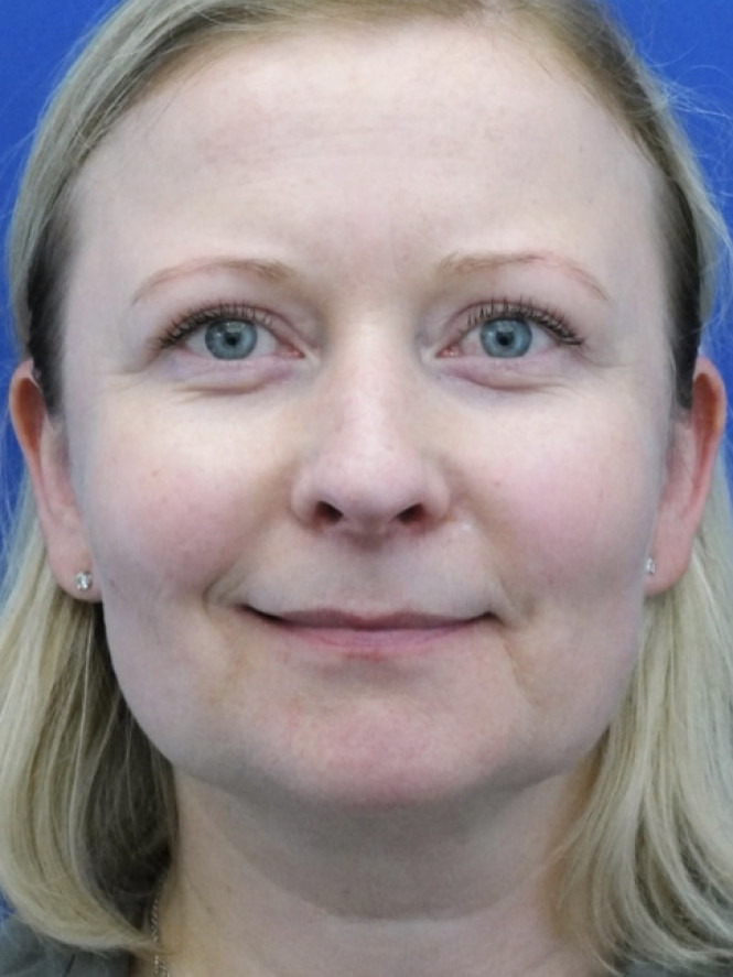 Eyelid Lift and Brow Fat Suspension — After