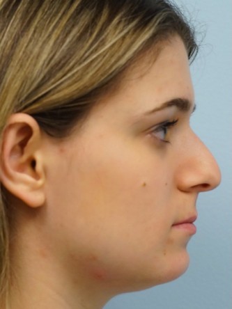 Droopy Tip Endonasal Rhinoplasty* — Before