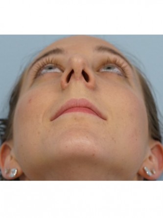 Nasal Hump Endonasal Rhinoplasty* — After
