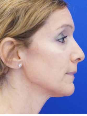 Mild Neck Skin Laxity — Before