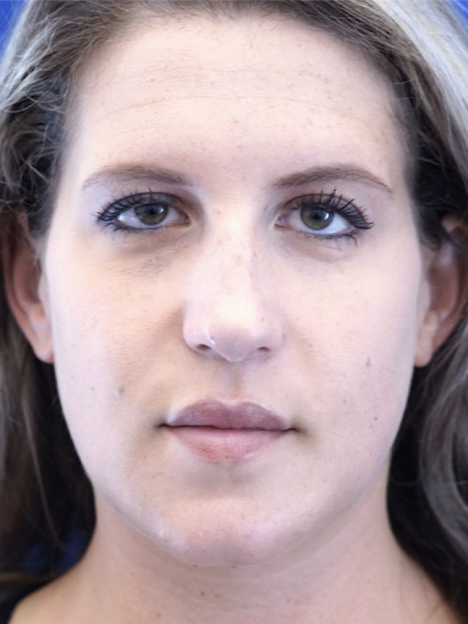Aesthetic Nasal Profile — Before