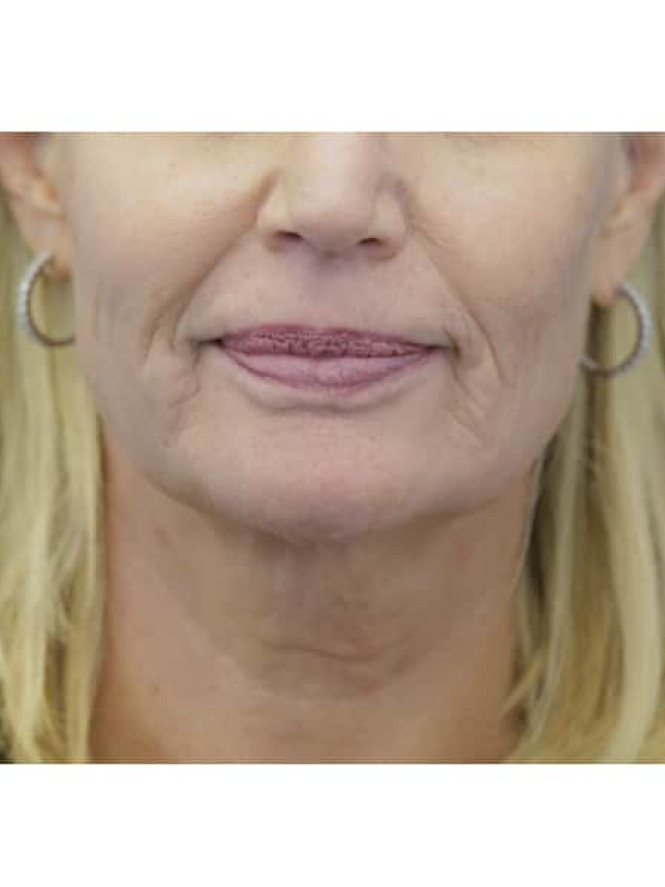 Crisp Profile Lines — Before
