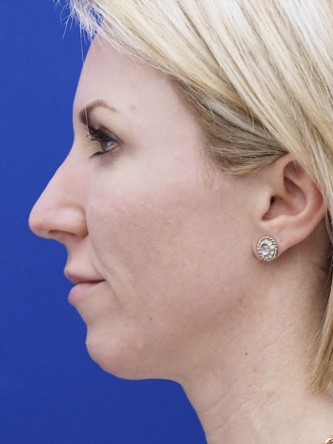 Aesthetic Nasal Contour* — Before