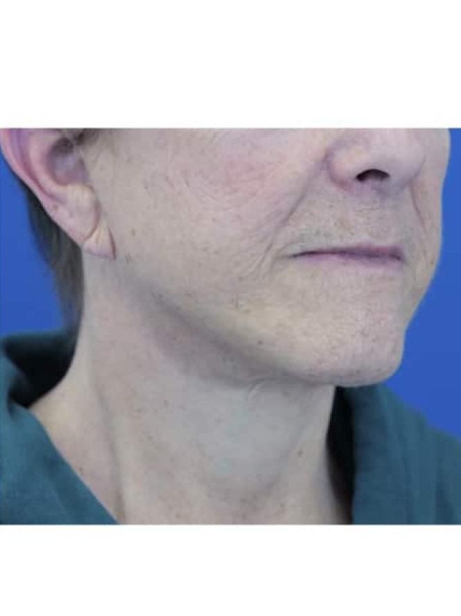 Neck Tissue Laxity — After