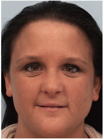 Juvederm to Upper & Lower Lips* — Before
