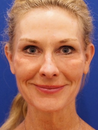 Mini Facelift* — Before
