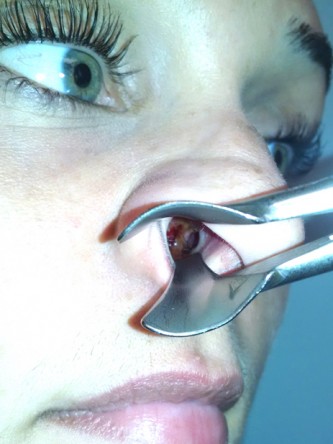 Nasal Septal Perforation1* — Before