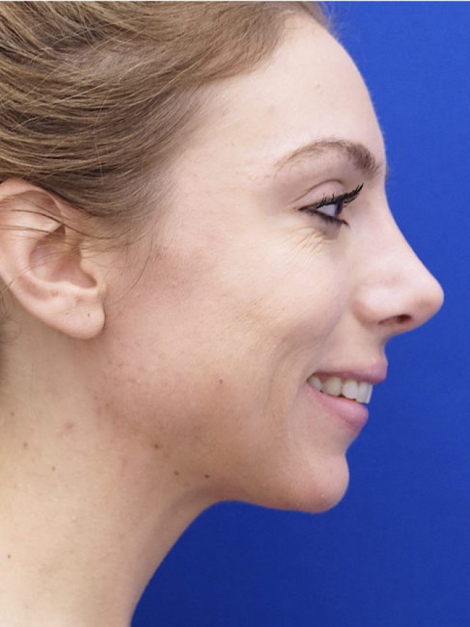 Endonasal Dainty Nose — After