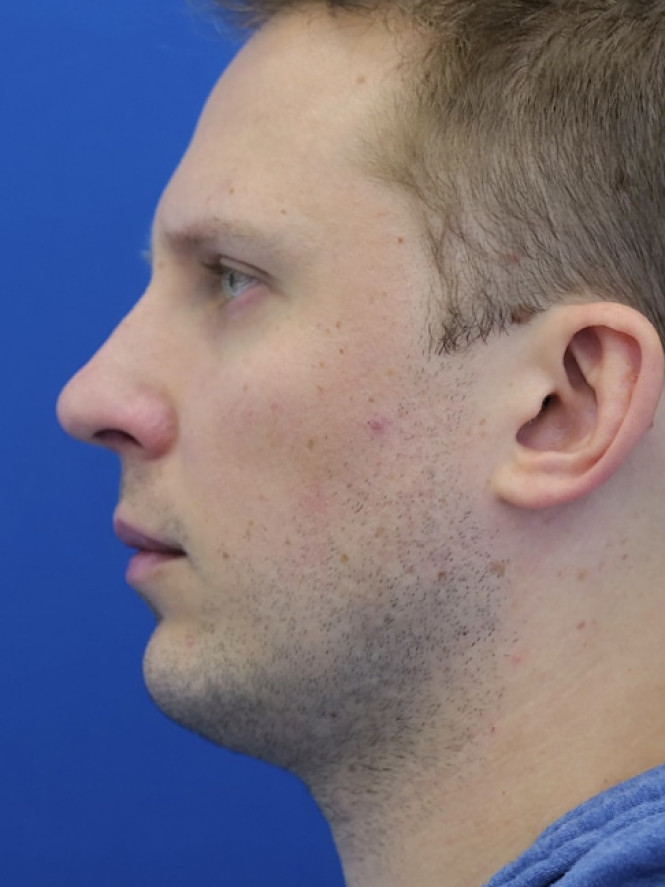 Dorsal Hump and Chin Augmentation — After