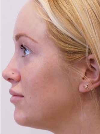Restylane Silk to Upper & Lower Lips* — After