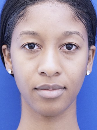 Ethnic Rhinoplasty* — Before