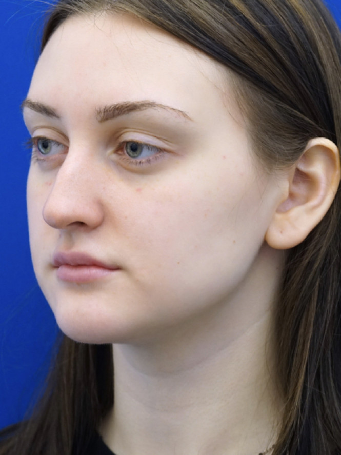 Natural Profile — Before