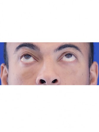 Fat Transfer to Lower Eyelid* — After