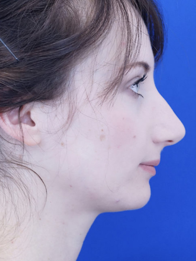 Gentle Dorsal Slope — Before