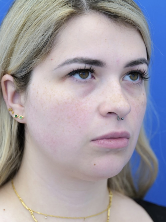 Underchin Fullness — Before