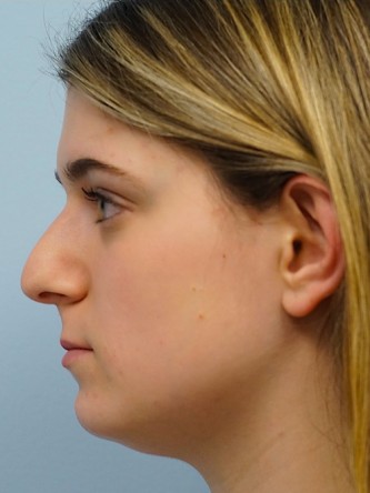 Droopy Tip Endonasal Rhinoplasty* — Before