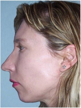 Chin Implant* — Before