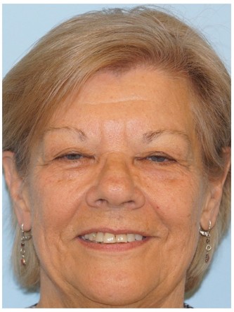 Upper Eyelid Droop and Skin Excess* — Before