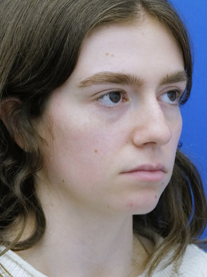 Preservation Rhinoplasty1 — Before