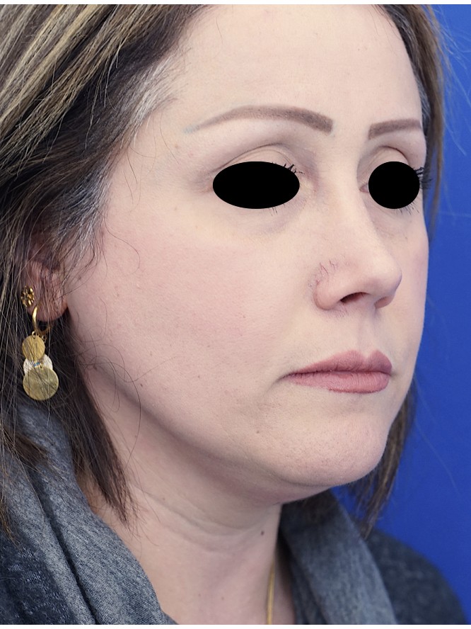Over-Resected Nose — After
