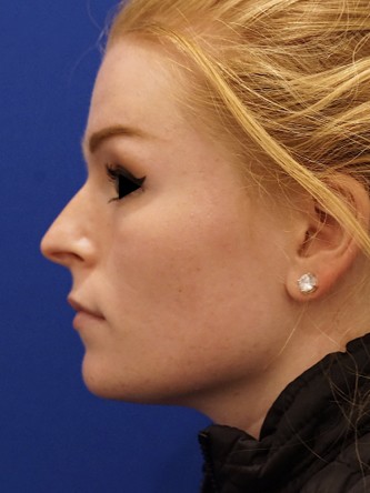 Tip and Lip* — Before